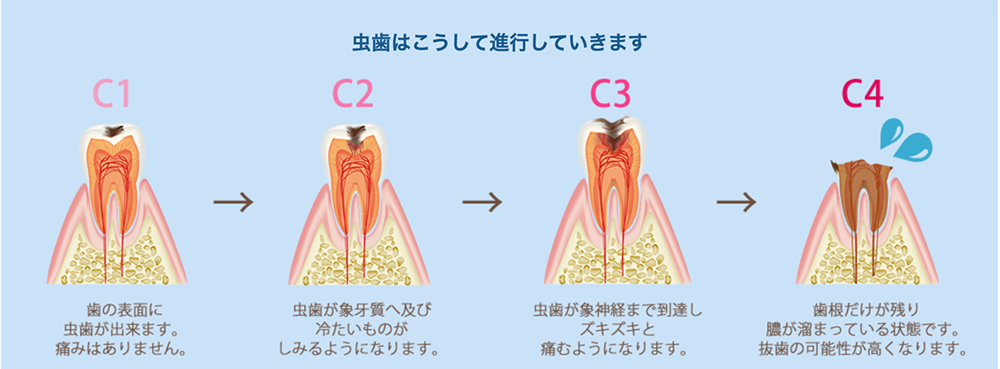 むし歯の進行について