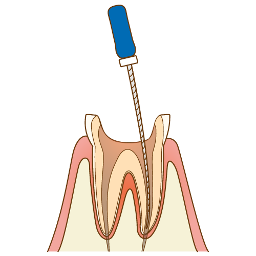 歯の根の治療です